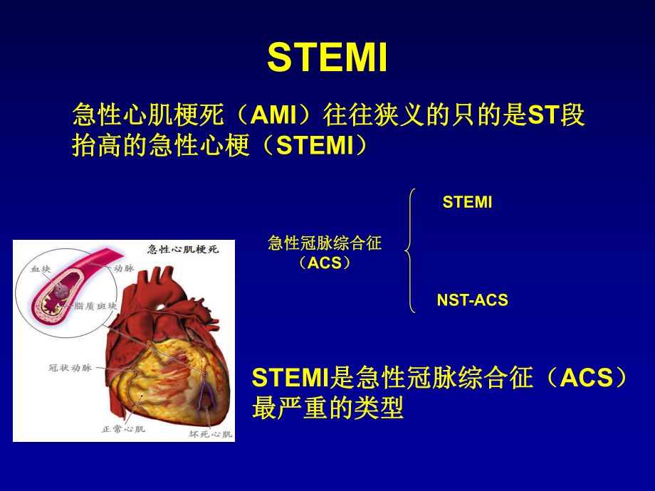 一例急性心肌梗死患者的药学监护课件.ppt_第2页