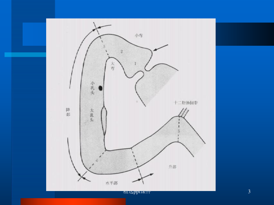 《十二指肠疾病》课件.ppt_第3页