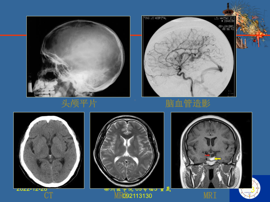 CTMRI颅脑影像看片课件.ppt_第3页