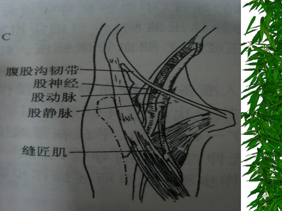 假性动脉瘤课件.ppt_第3页