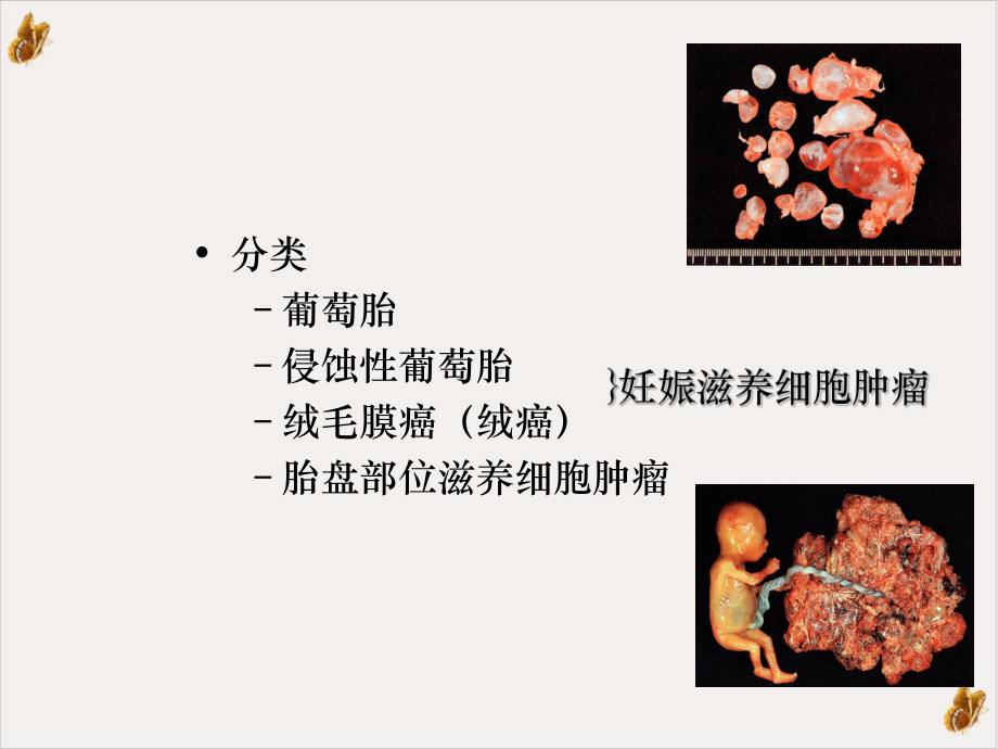 妊娠滋养细胞疾病病理临床表现诊断治疗课件.ppt_第3页