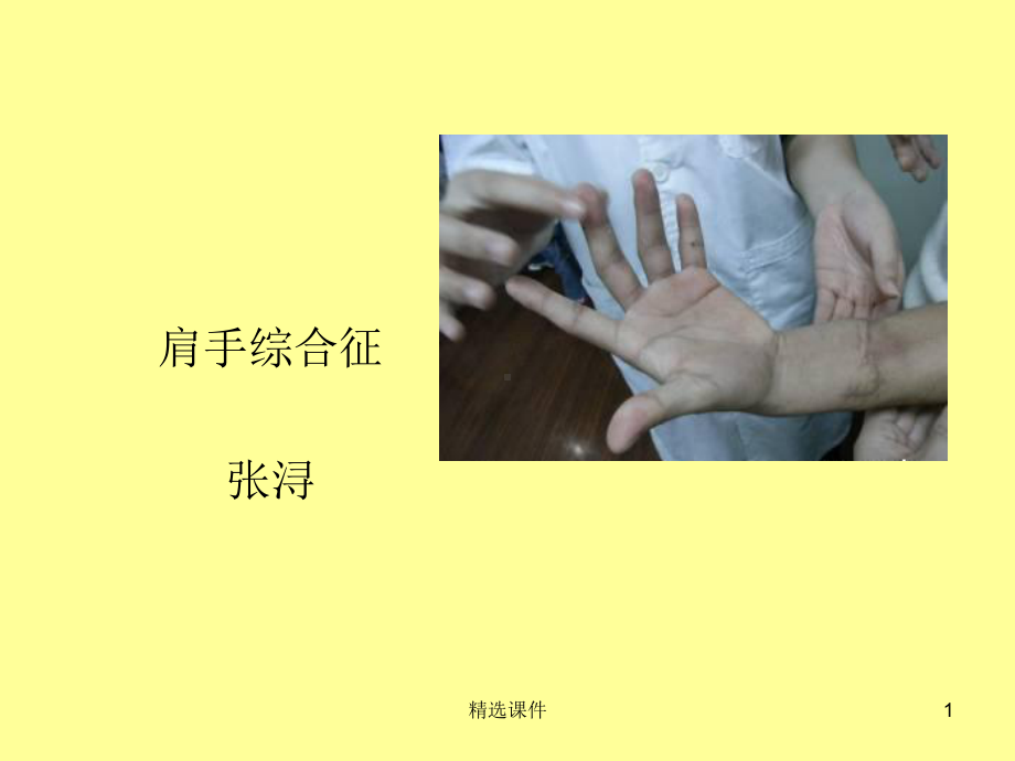 《肩手综合征》课件.ppt_第1页