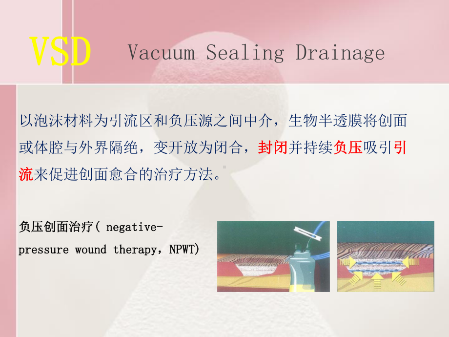 VSD技术的临床应用课件.ppt_第3页