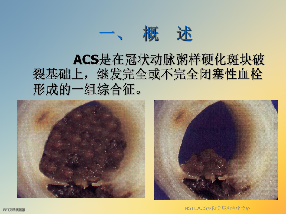 NSTEACS危险分层和治疗策略课件.ppt_第3页