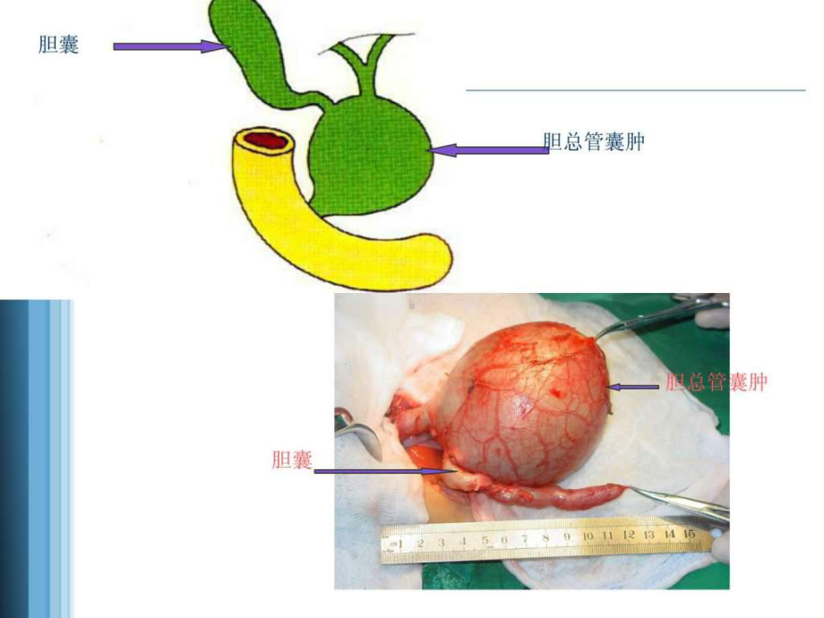 先天性胆总管囊肿护理查房课件整理.ppt_第2页