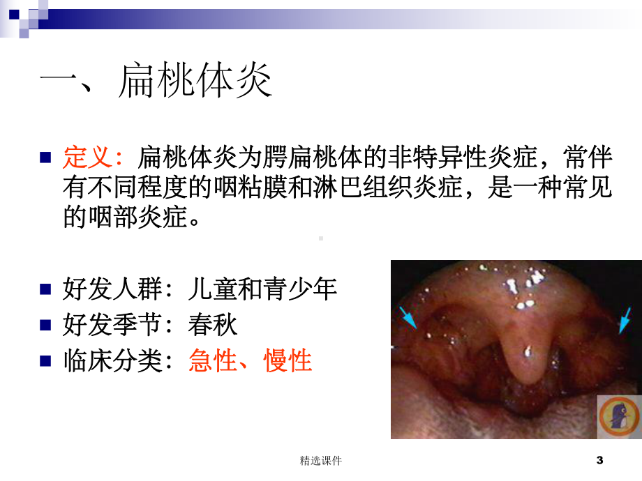 咽喉疾病的护理课件.ppt_第3页