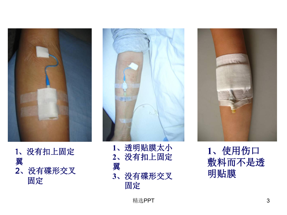 PICC维护及并发症的处理课件.ppt_第3页