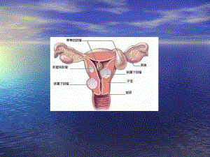 子宫肌瘤完整版课件.ppt