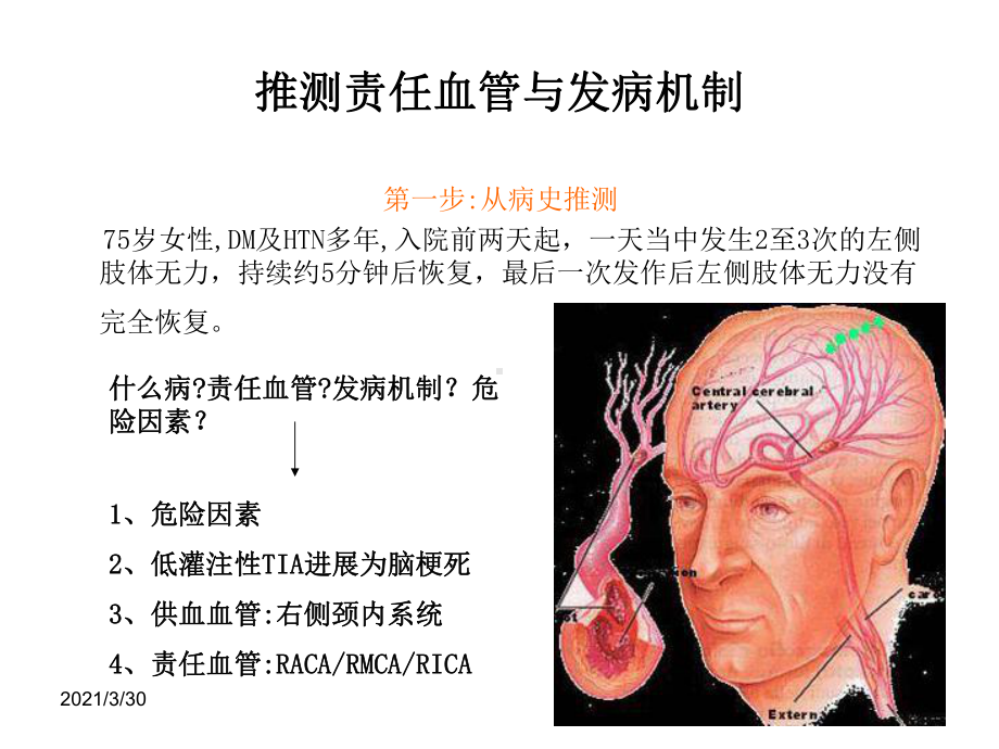 从影像学梗死部位推测责任血管和发病机制课件.ppt_第2页