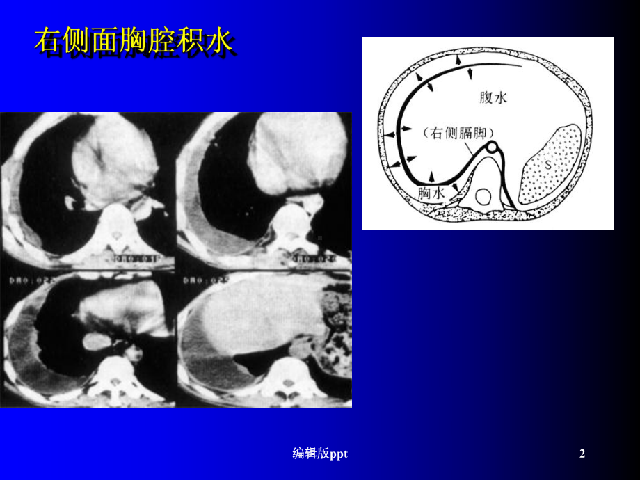 CT诊断胸腹水课件.ppt_第2页