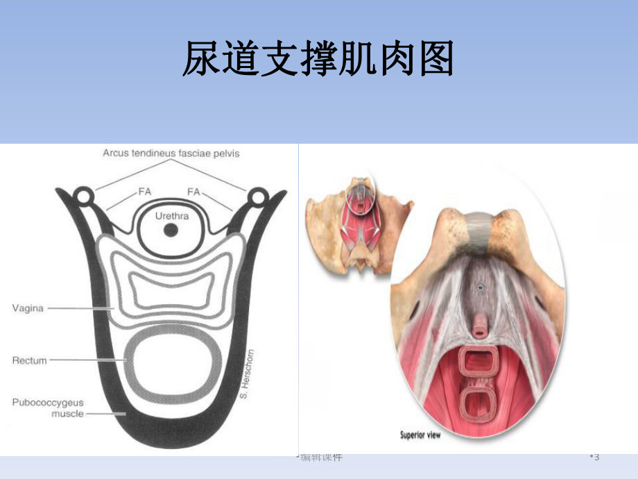 sling手术方式选择的思考课件.ppt_第3页