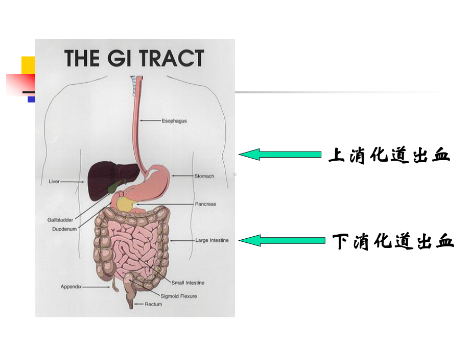 上消化道大出血患者的护理课件.ppt_第2页