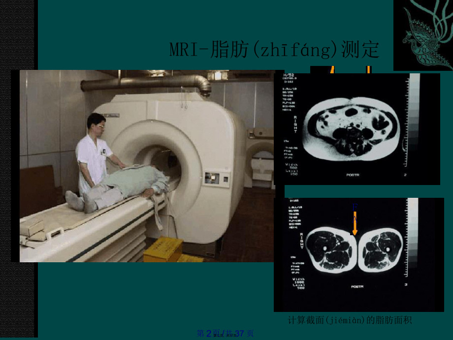 代谢综合征护理课件.ppt_第2页