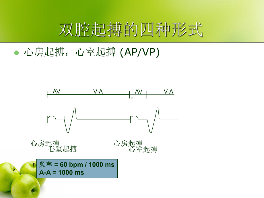 双腔起搏器技术及临床心电图表现课件整理.ppt_第2页