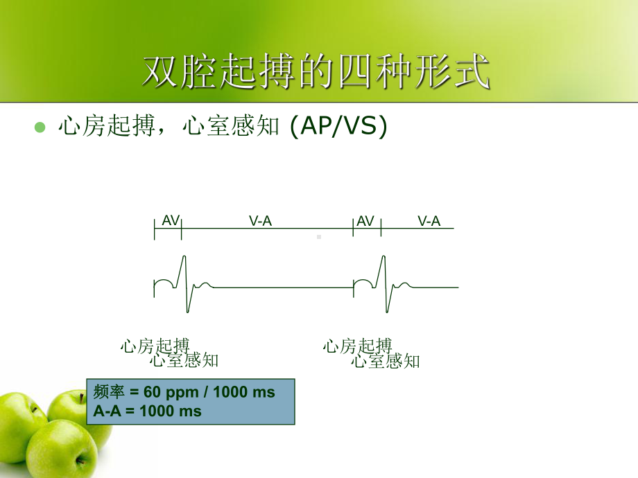 双腔起搏器技术及临床心电图表现课件整理.ppt_第3页