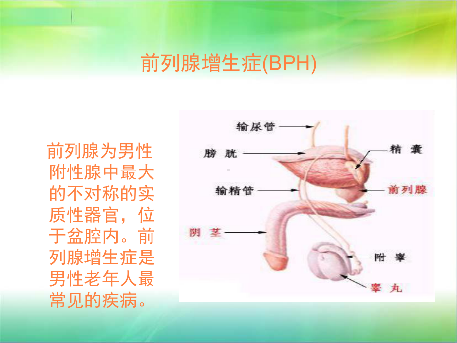 前列腺增生症课件整理.ppt_第2页