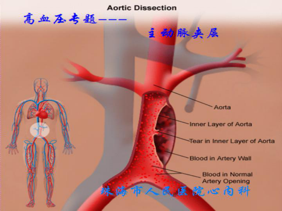 主动脉夹层自做课件.ppt_第1页