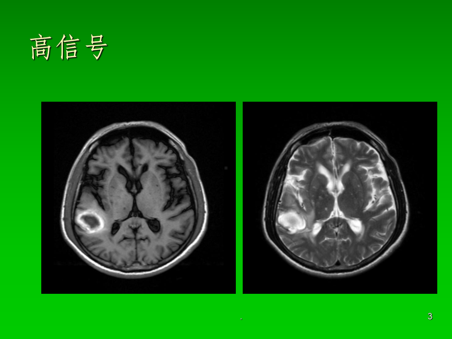 MRI中枢神经系统疾病基本阅片技能课件.ppt_第3页