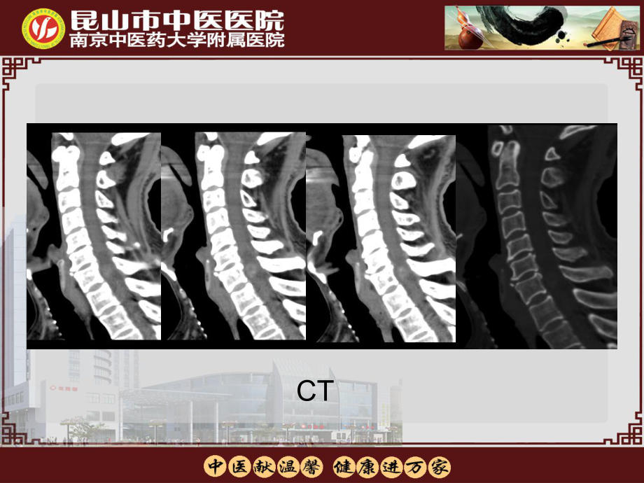 原始神经外胚层肿瘤MRI表现课件.ppt_第3页