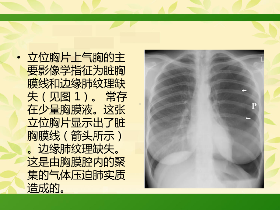 气胸的X线表现课件.pptx_第3页