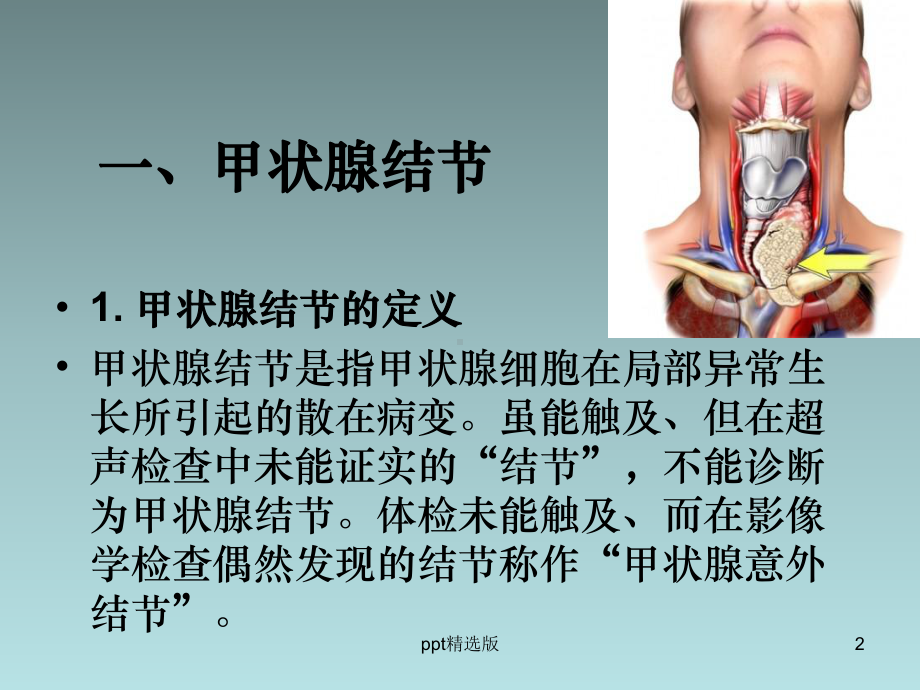 甲状腺结节诊治和DTC手术治疗课件.ppt_第2页