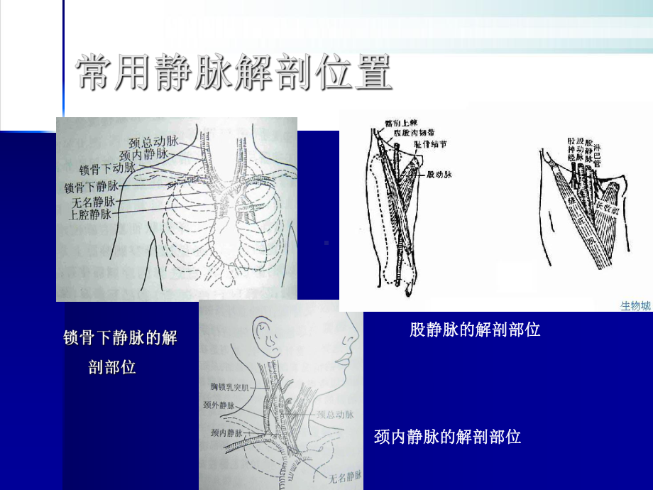 深静脉置管术的配合与护理课件.pptx_第3页