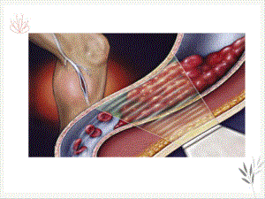深静脉血栓形成的诊断和治疗课件.pptx