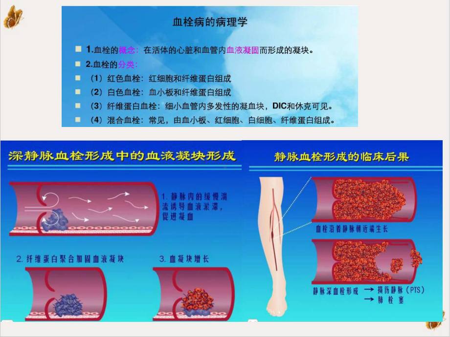 深静脉血栓形成的诊断和治疗培训课件.pptx_第3页