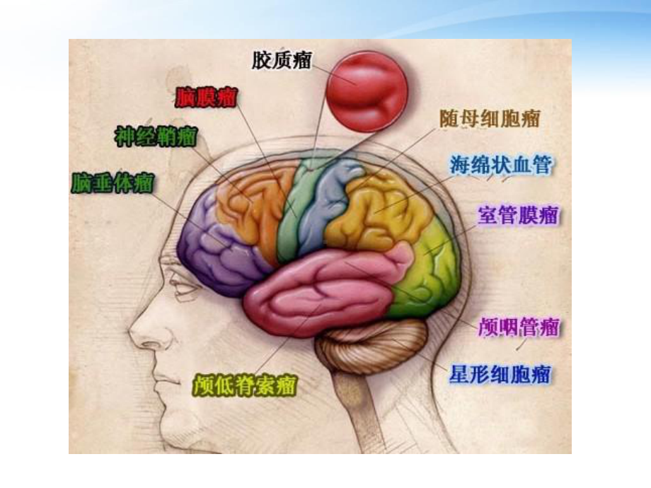 常见脑肿瘤的影像诊断课件(同名279).ppt_第3页