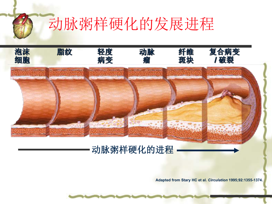 急性心肌梗死护理课件(同名1184).ppt_第3页