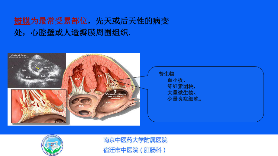 感染性心内膜炎护理查房PP课件.ppt_第3页