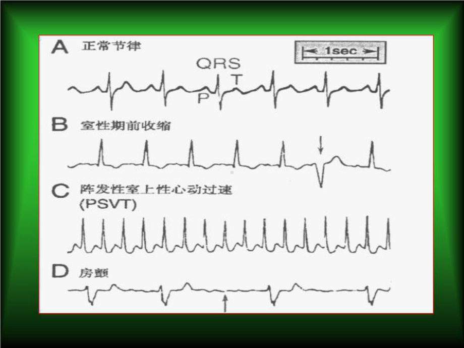 最新抗心律失常药课件.ppt_第3页
