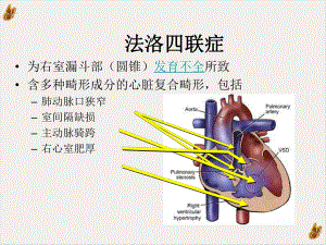 法洛四联症心律失常课件.pptx