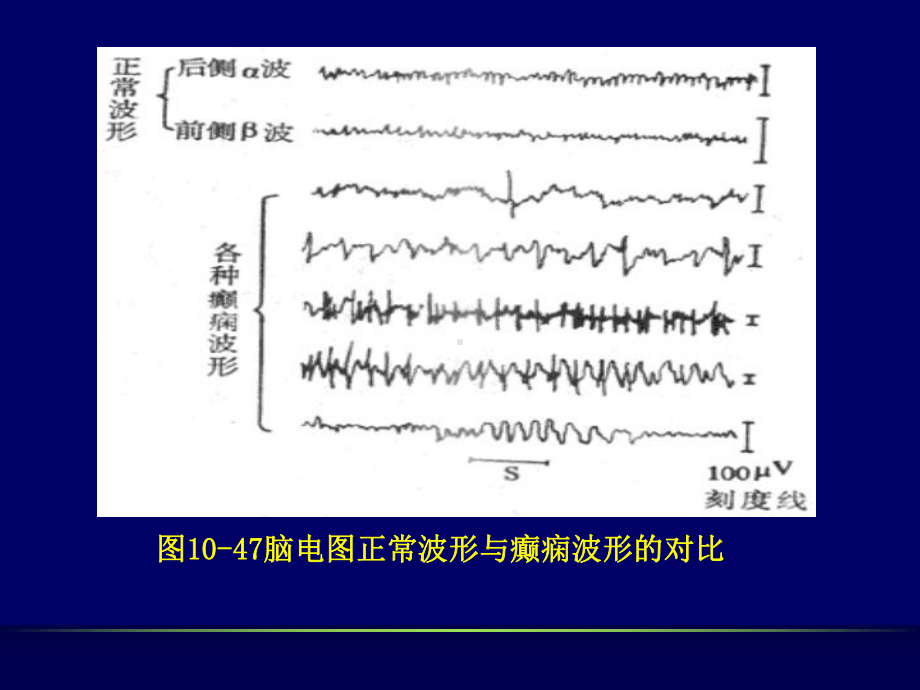 抗癫痫药物及抗惊厥药物课件.ppt_第3页