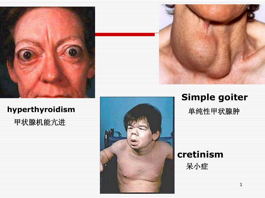 甲状腺素课件.ppt_第1页