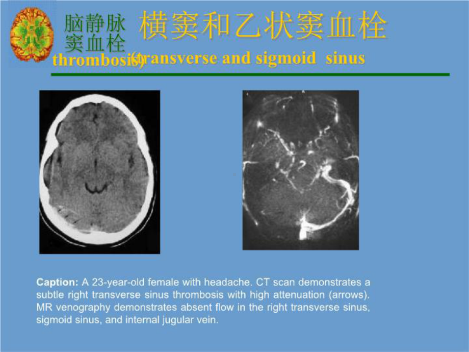 最新横窦和乙状窦血栓课件.ppt_第3页