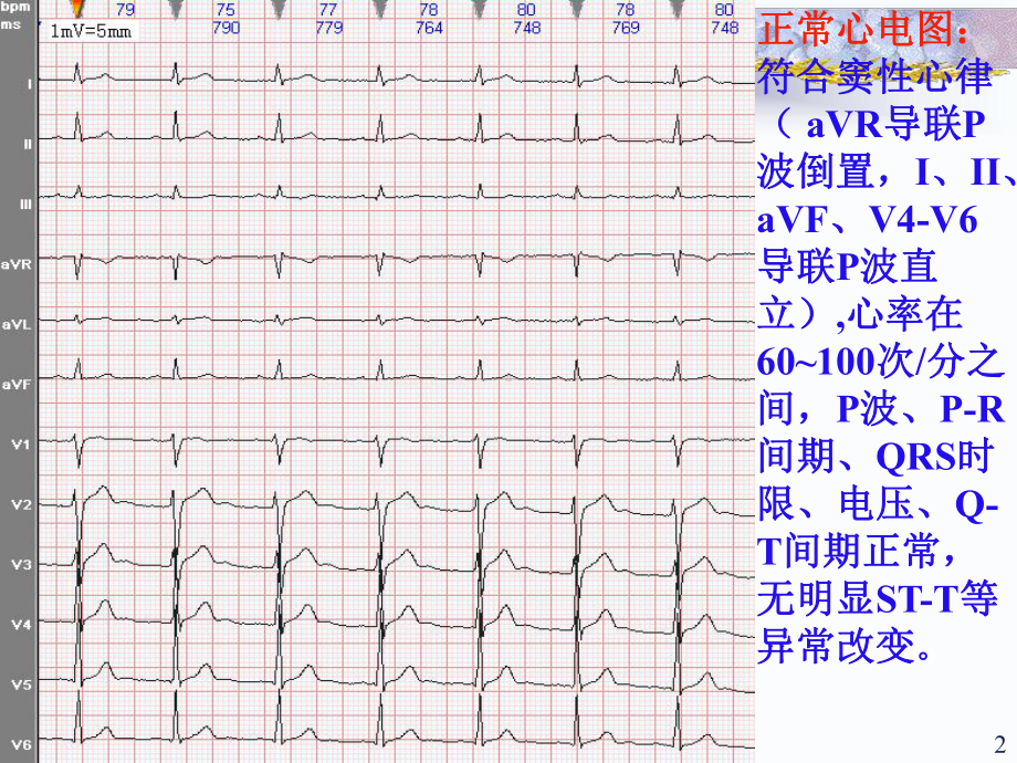 常见心电图诊断课件整理.ppt_第2页