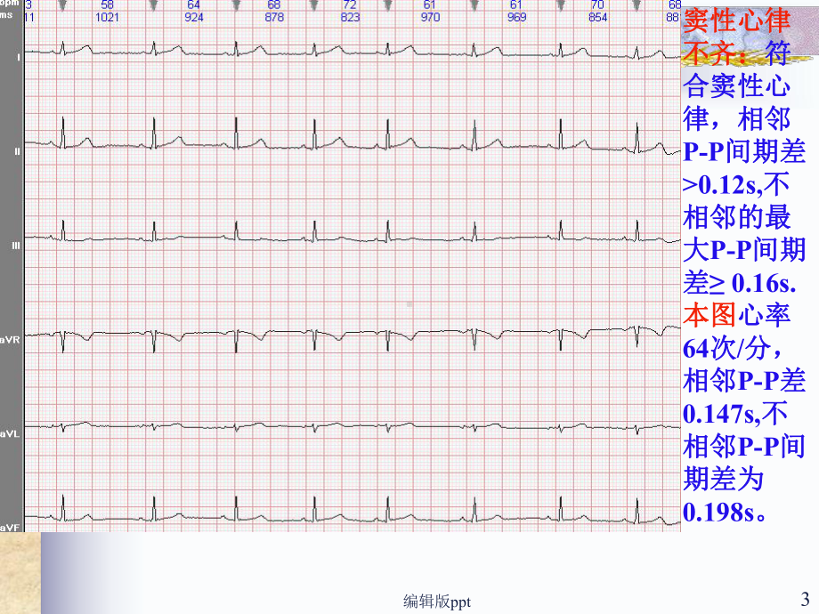 常见心电图诊断课件整理.ppt_第3页