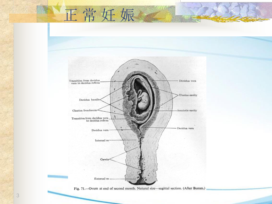 异位妊娠的专业培训课件.ppt_第3页