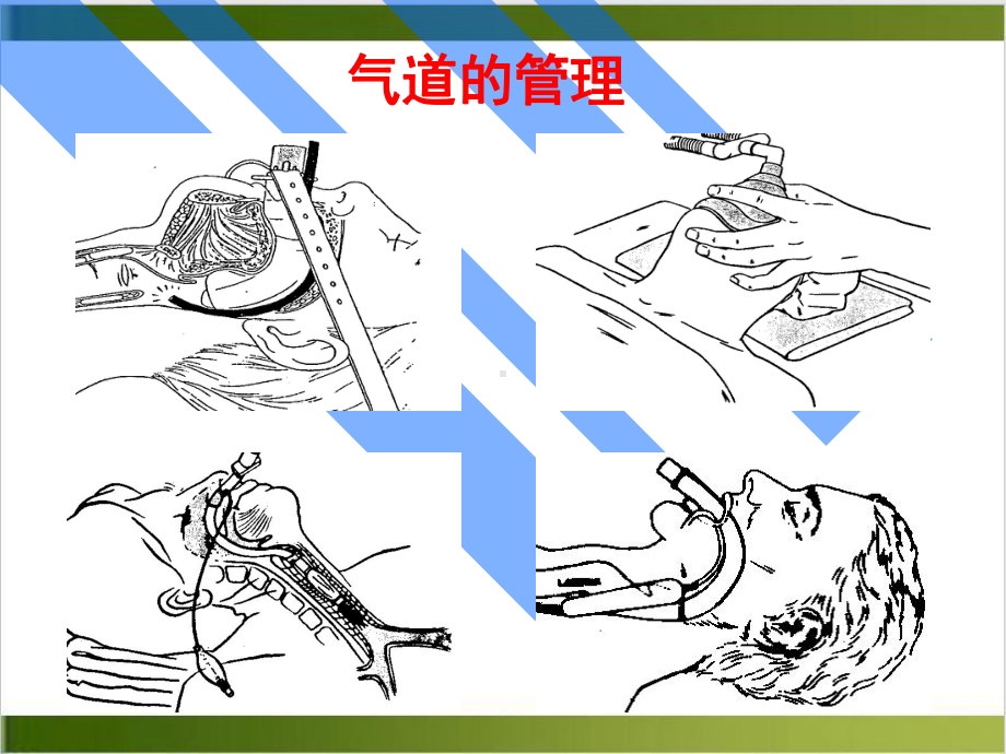 气管及支气管内插管术课件(同名59).pptx_第1页