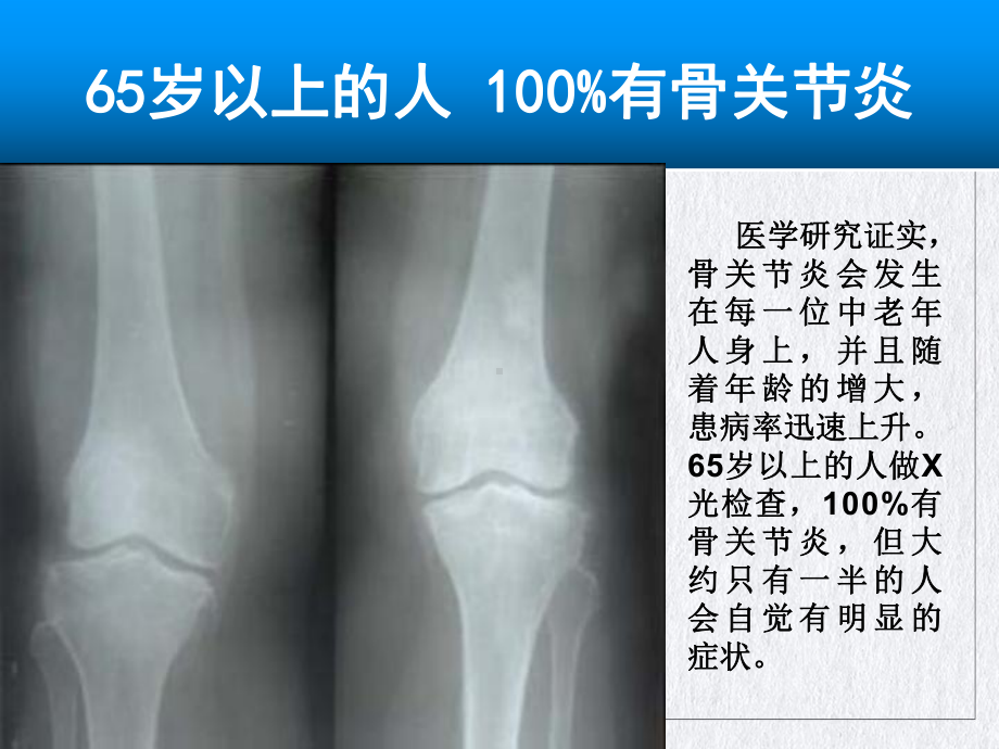 氨糖与骨关节讲课课件.pptx_第2页