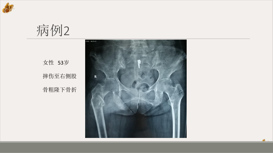 甲状旁腺亢进棕色瘤影像诊断课件.pptx_第3页