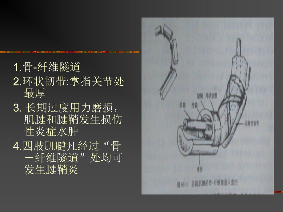 最新三狭窄性腱鞘炎课件.ppt_第2页