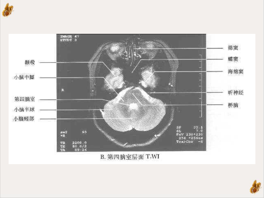 枢神经系统常见肿瘤的诊断课件.ppt_第3页