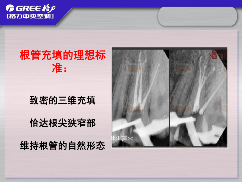 根管治疗术(五)：根管充填课件.ppt_第3页