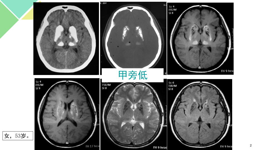 甲状旁腺功能减退症(课堂)课件.ppt_第2页