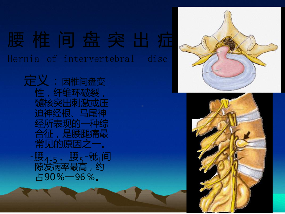 椎间孔镜治疗腰椎课件.ppt_第2页