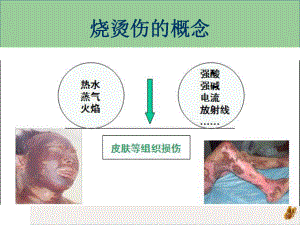 烧烫伤急救处理课件.pptx