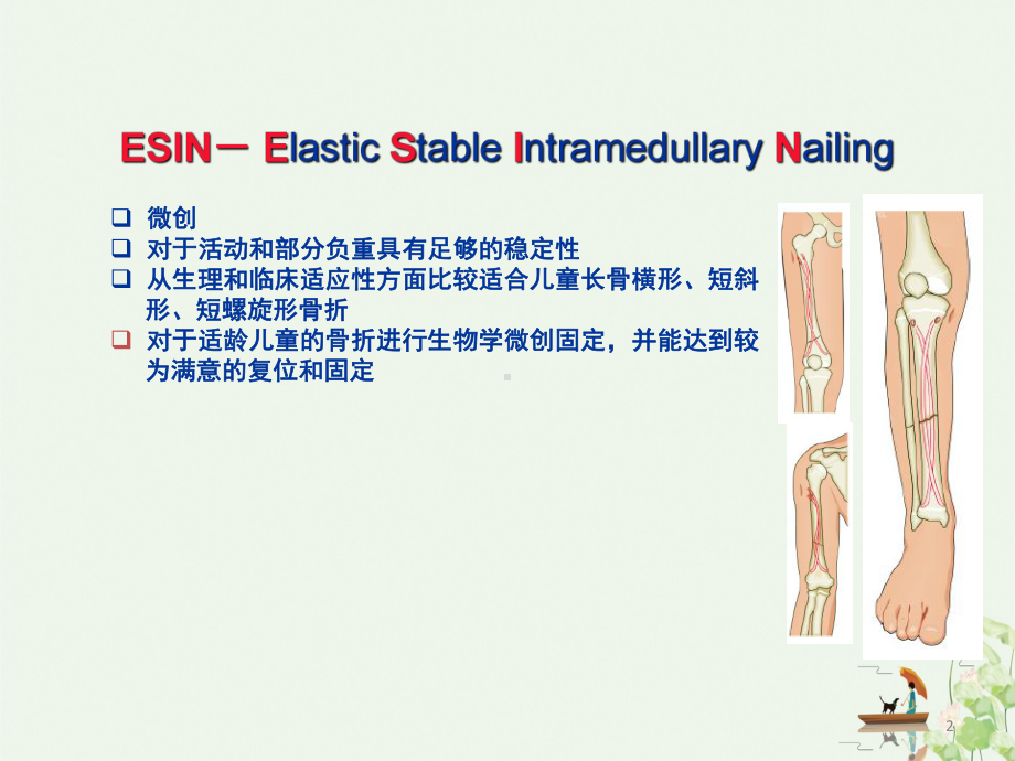 弹性髓内钉治疗儿童长骨骨折讲课课件.ppt_第2页