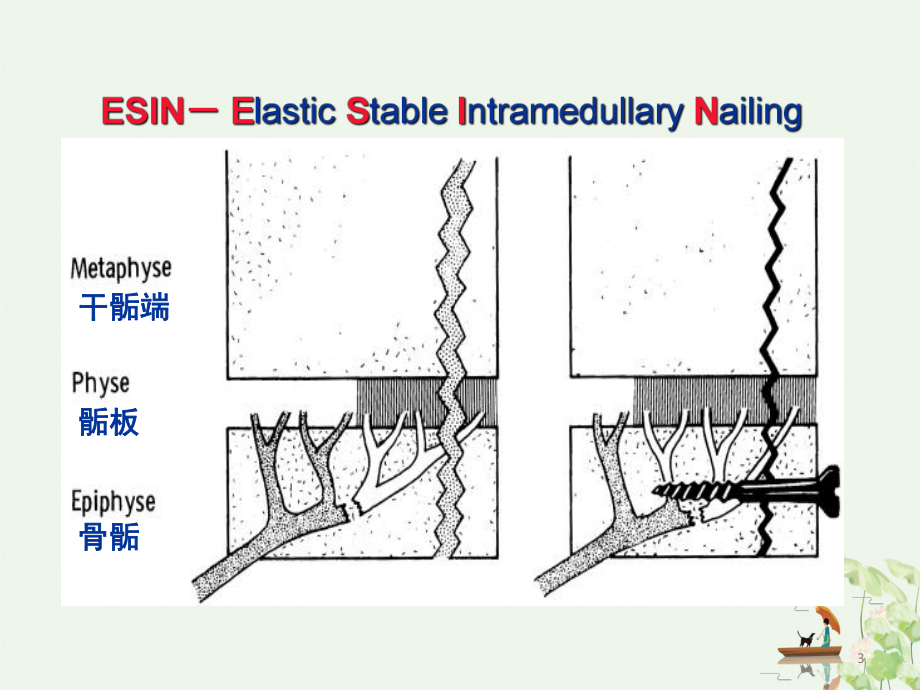 弹性髓内钉治疗儿童长骨骨折讲课课件.ppt_第3页